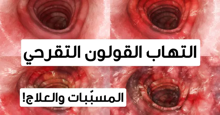 تأثير القولون التقرحي على الزواج: دليل شامل لتجاوز التحديات الزوجية