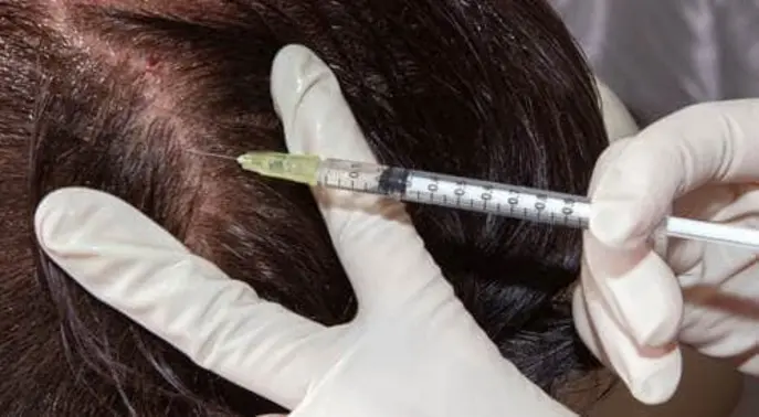 كيف تتم زراعة الشعر؟ دليلك الشامل لاستعادة كثافة شعرك